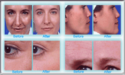microdermabrasion before and after icon